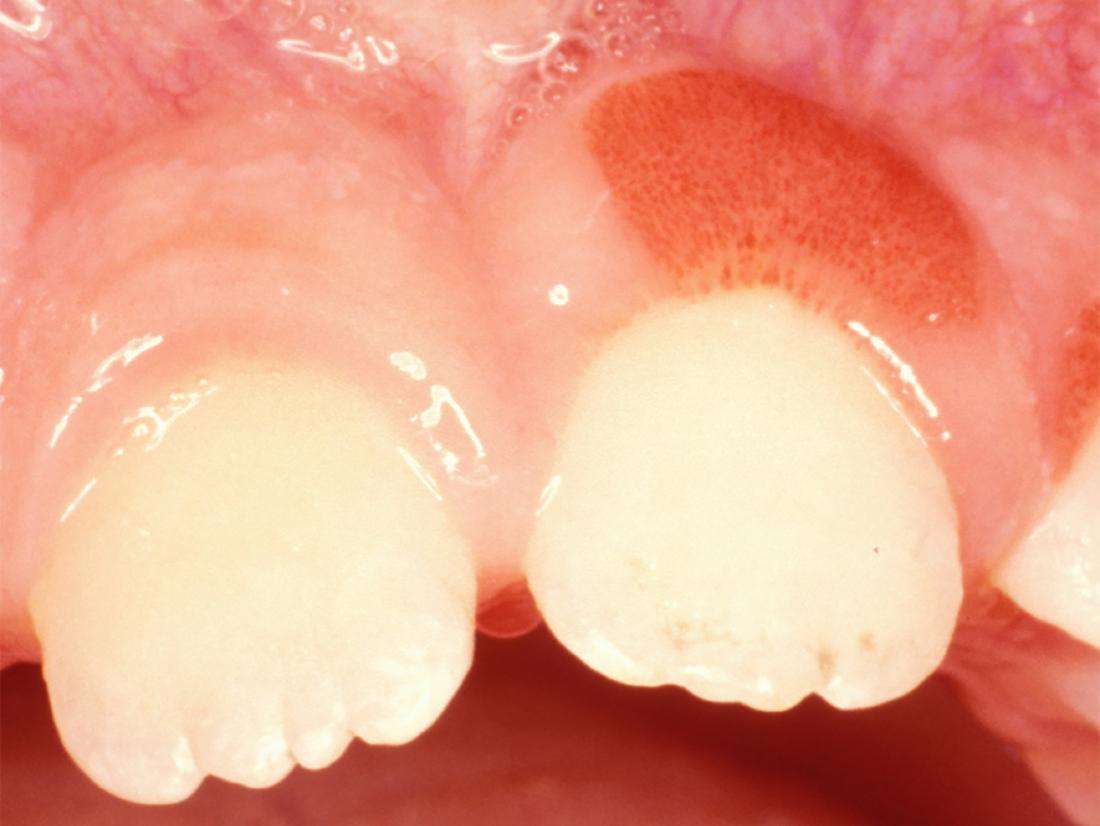 Swollen gum around one tooth: Causes and treatment