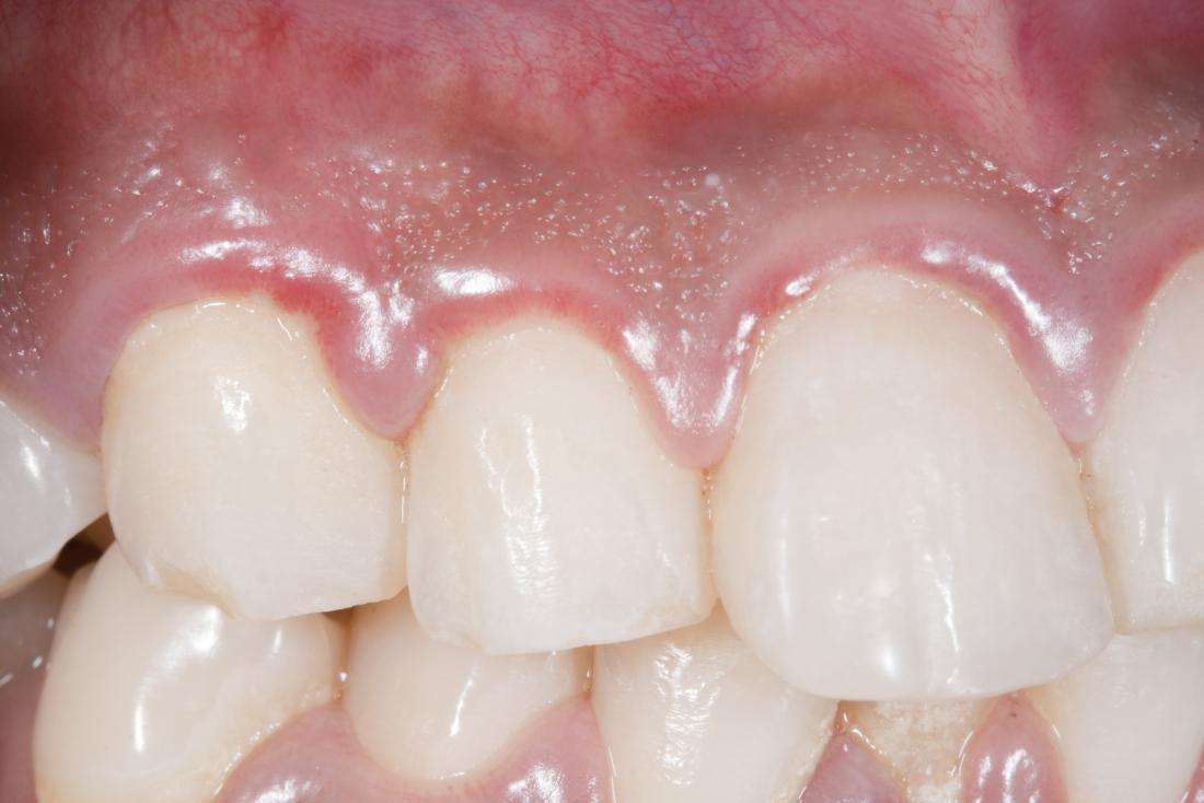Swollen gums: Causes, treatments, and home remedies