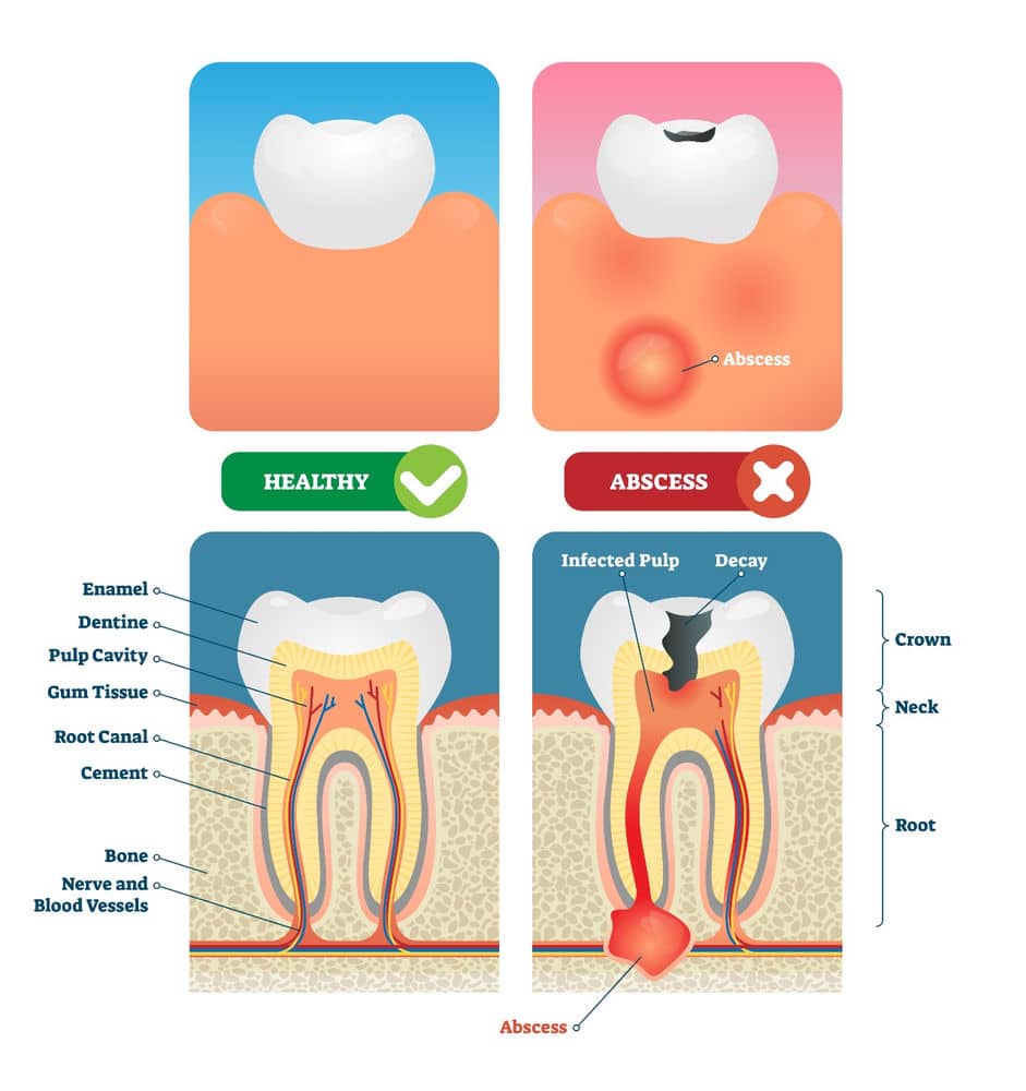 Symptoms, Causes, and Treatments for an Abscessed Tooth