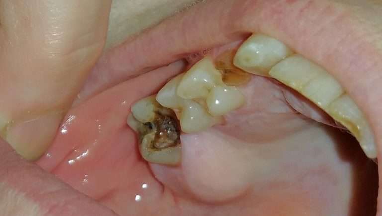 Symptoms of tooth infection spreading