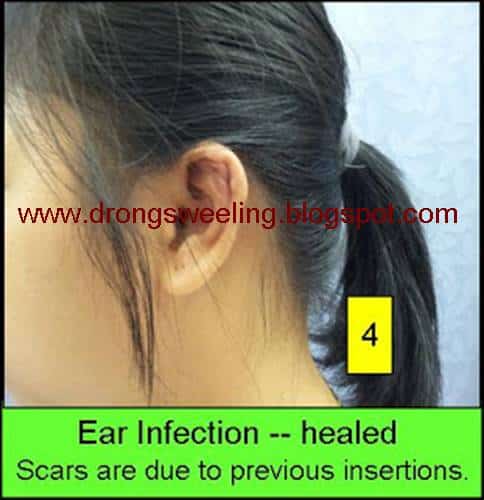 TCM News: How TCM Physicain Cures Ear Infactions