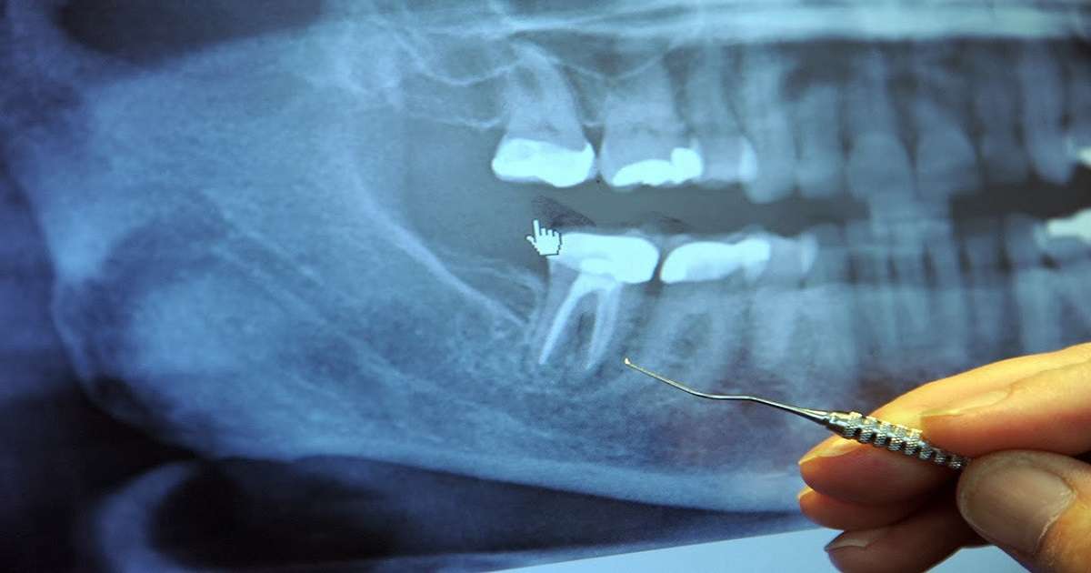 This dentist refused to perform any root canal for over 20 years.The ...