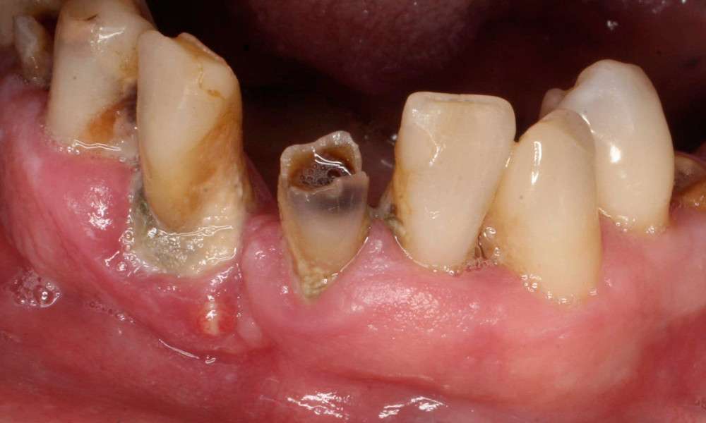 Tips On Treating The Wisdom Teeth Infection