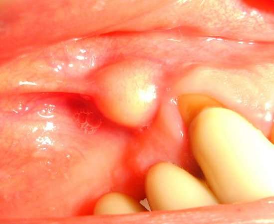 Tooth Abscess Guide: Dental Infection Symptoms and Treatment