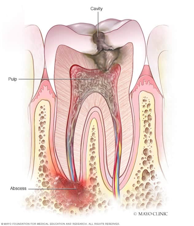 Tooth abscess