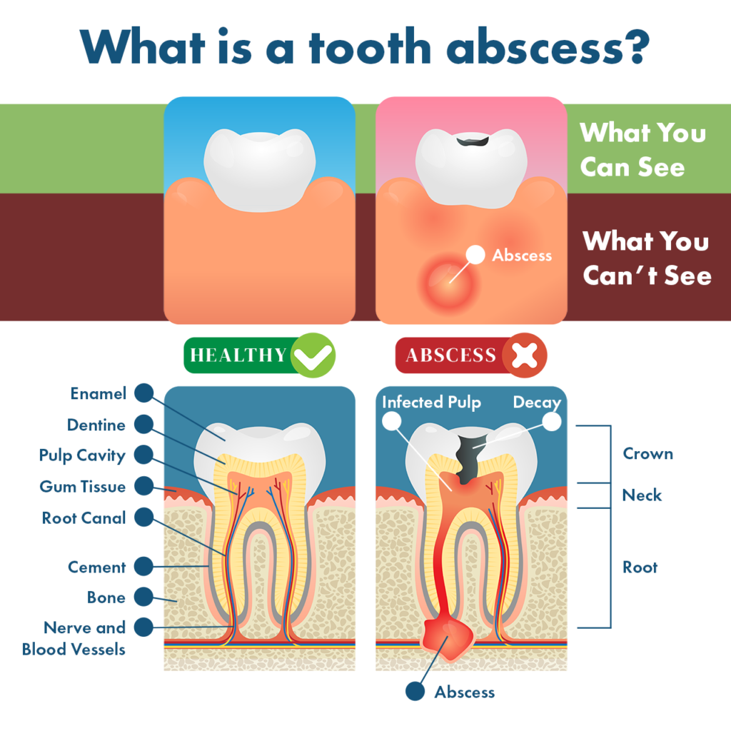 Tooth Abscess Symptoms, Remedies, Complications &  Prevention
