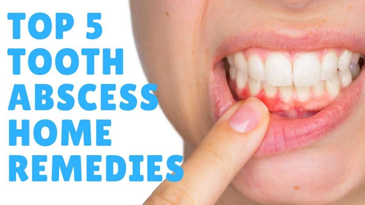 Tooth Abscess: Top 5 Tooth Abscess Home Remedies &  Treatments