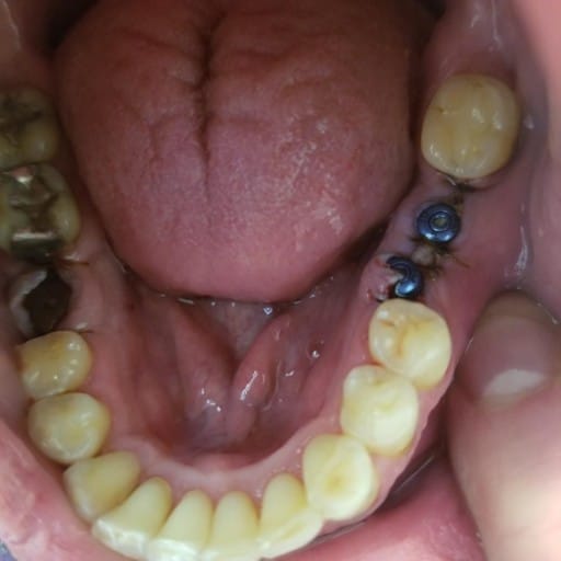 Tooth Broken off the Gum line