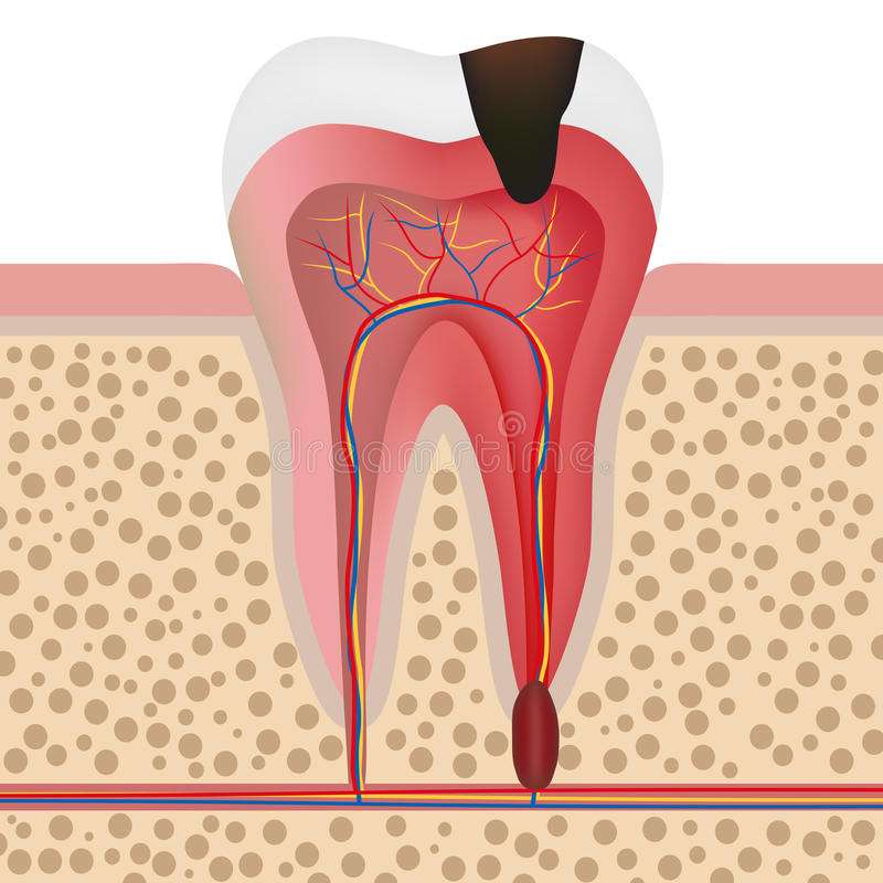 Tooth decay formation stock vector. Illustration of infection