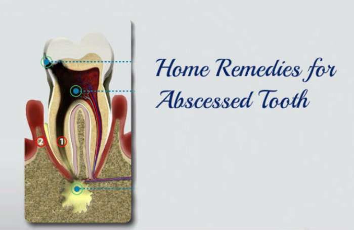 Top 20 Proven Home Remedies for Abscessed Tooth