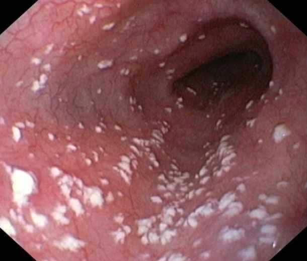 Treatment for Candidiasis known as vaginal Yeast Infection by Dr. Tsan