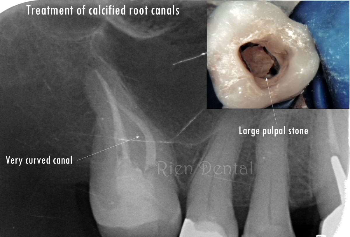 Treatment of calcified root canals.