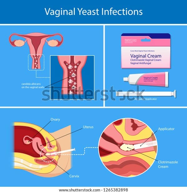 Vaginal Yeast Infections Treatment Applicator Symptoms Stock Vector ...