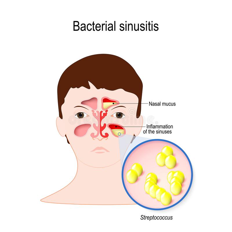 Viral Sinusitis Rhinitis Caused by Adenovirus Stock Vector ...