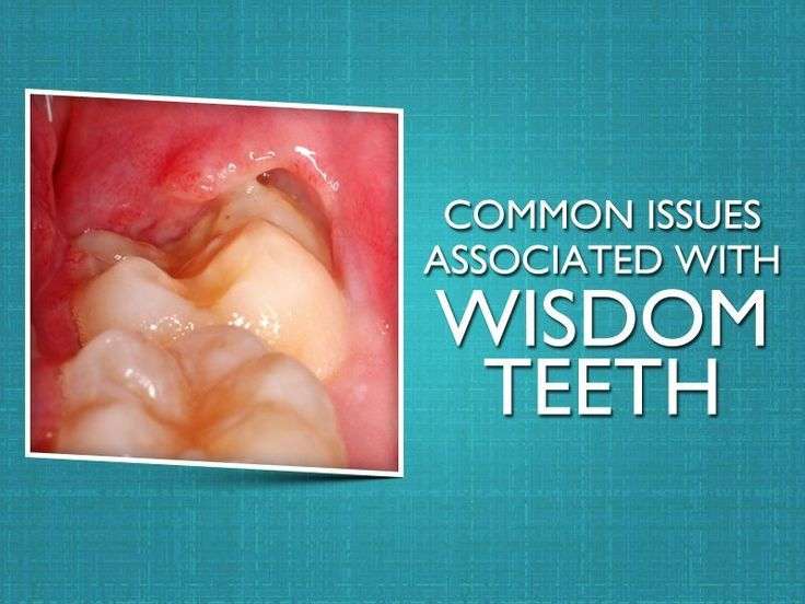 Wacky Tooth Decay Study #TeethWhiteningAtl #DentalOfficeRenovation ...