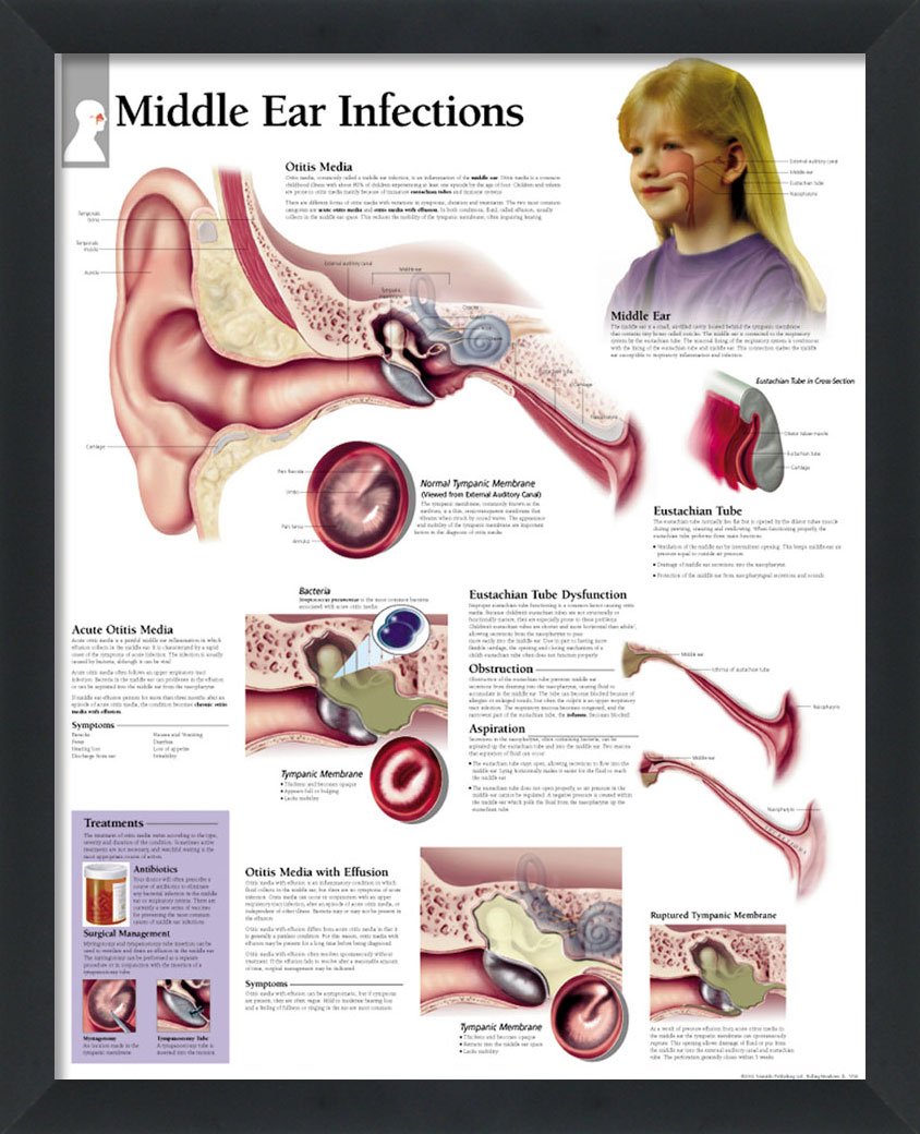 wallsthatspeak Middle Ear Infections Framed Medical Educational ...
