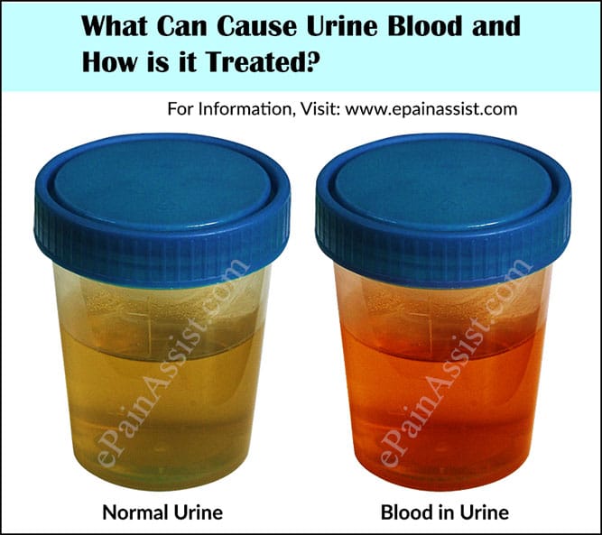 What Can Cause Urine Blood and How is it Treated?