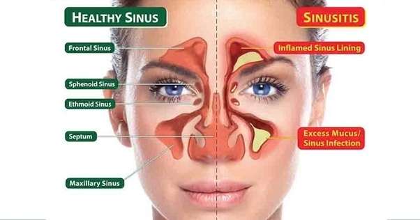 What causes my sinus glands to be swollen?
