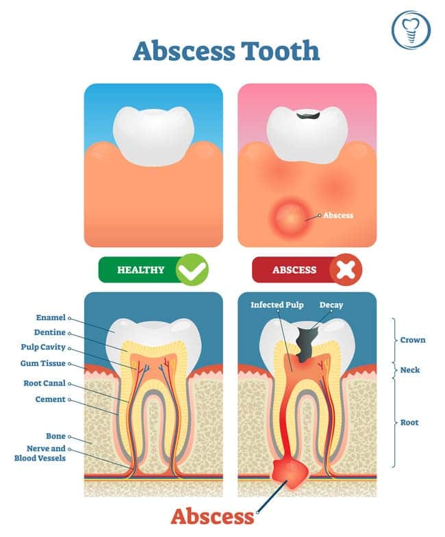 What Is A Dental Abscess?