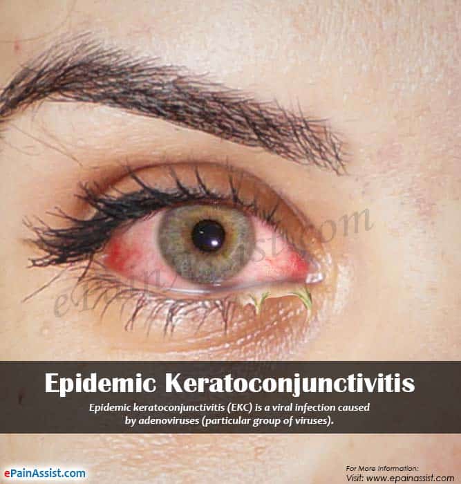 What is Epidemic Keratoconjunctivitis &  Is it Contagious?