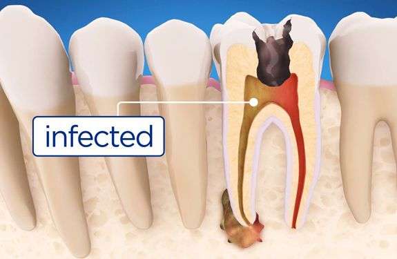 What is Root Canal &  Treatment Works?