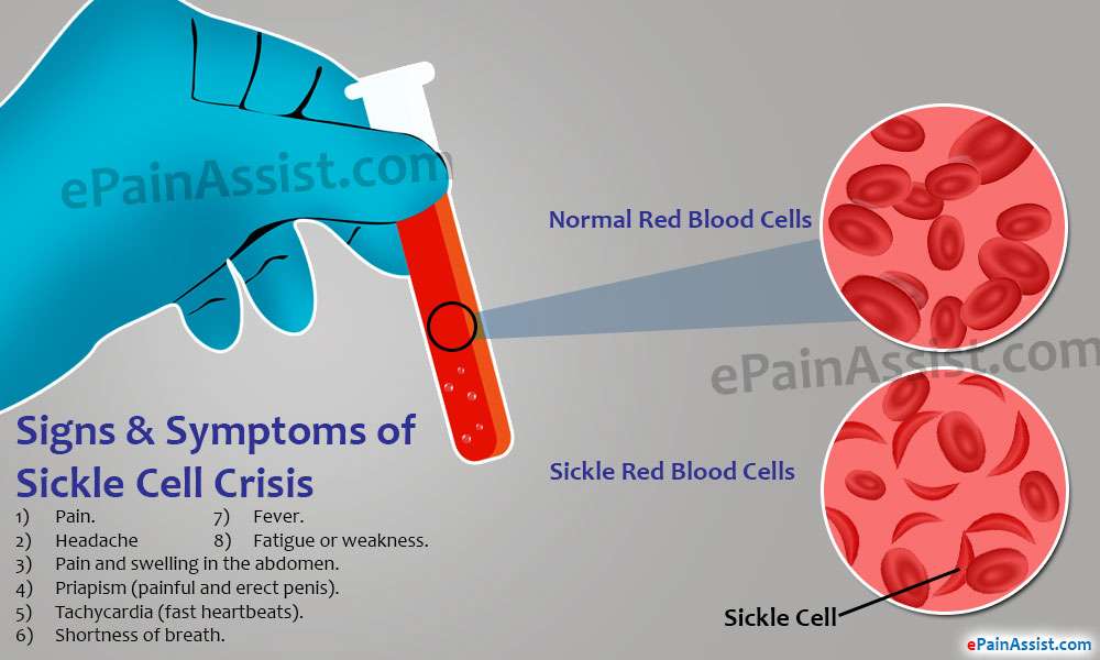 What is Sickle Cell Crisis and How is it Treated?