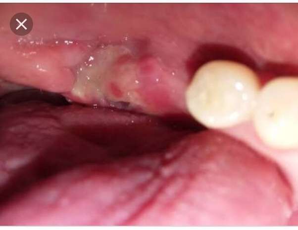 What is the yellow stuff coming out of my wisdom tooth hole?