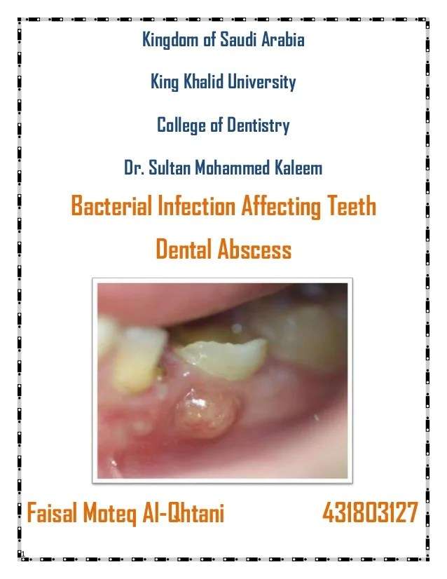 What kind of antibiotics treat tooth infection â YBHK