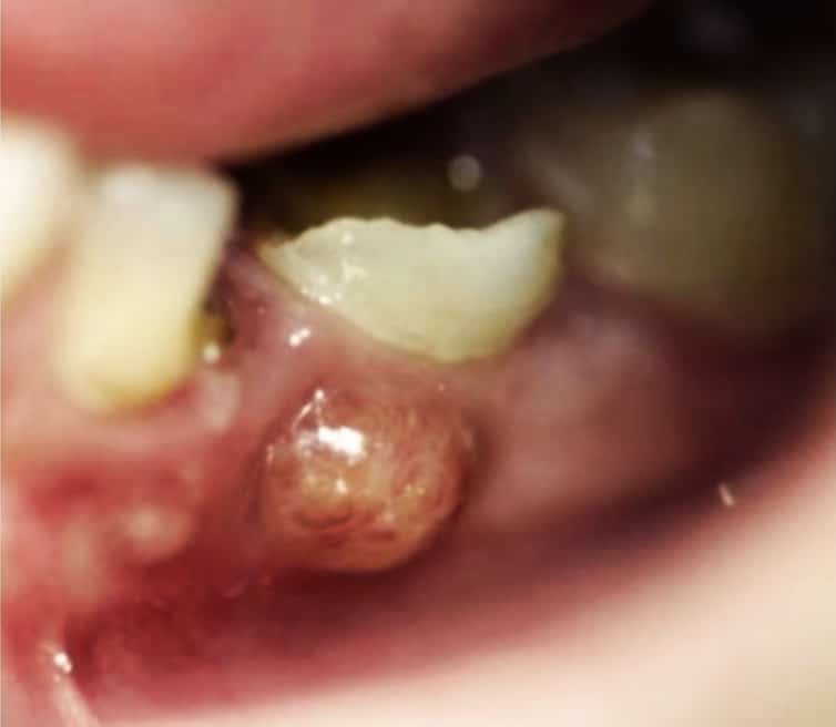 What to do about a fistula on the gums?