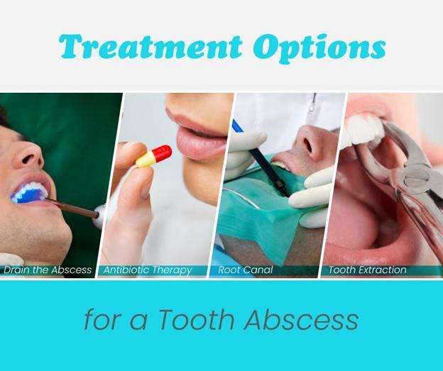 What to do if You Have a Tooth Abscess
