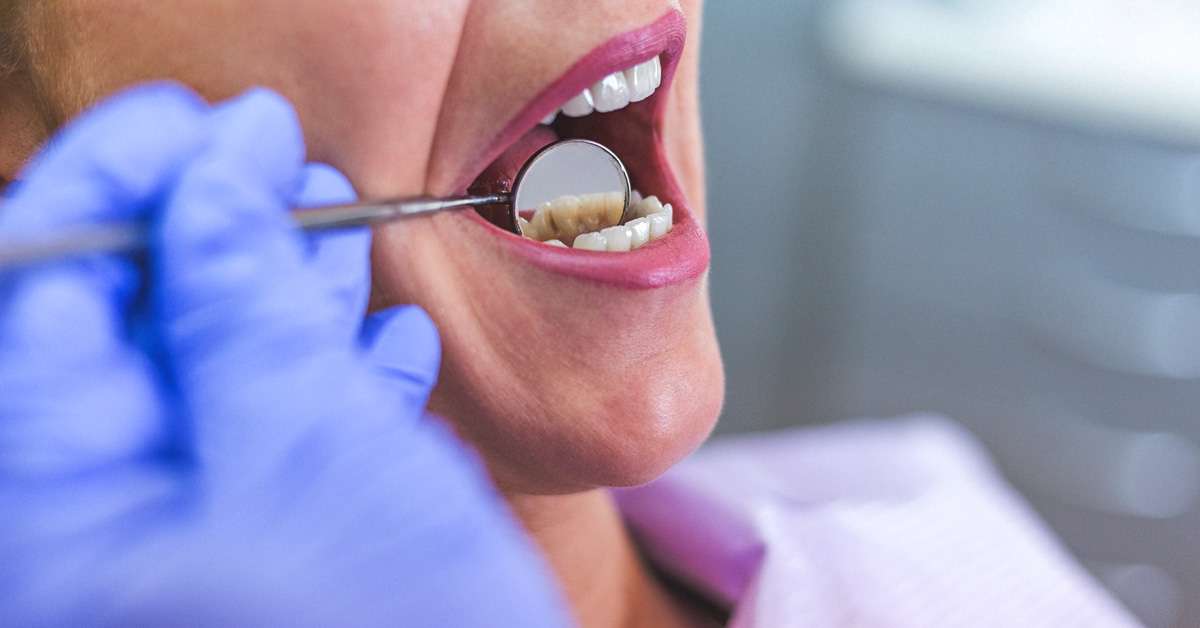What you Should know about Tooth Infections