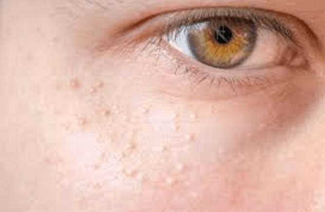 White Spots on Face, Causes, Under Eye, Fungus, Symptoms, Pictures, Not ...
