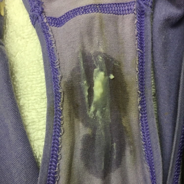 Why is my discharge like this?? Is this possibly a yeast infection? It ...