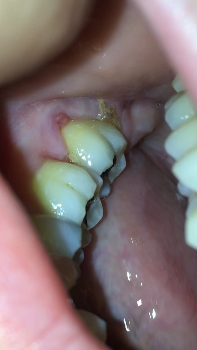 Wisdom teeth extraction infection?