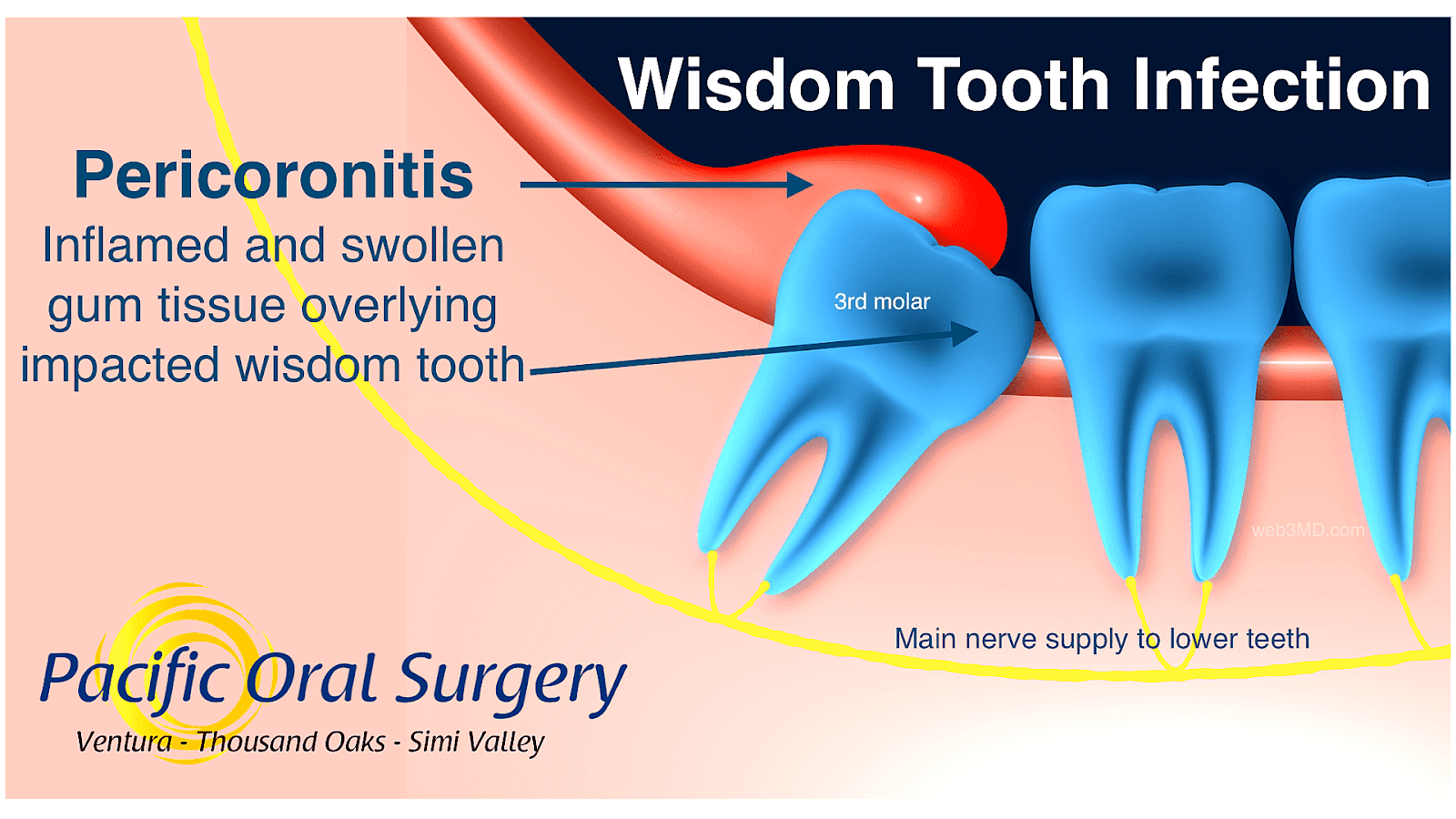 Wisdom Tooth Infection Treatment Home