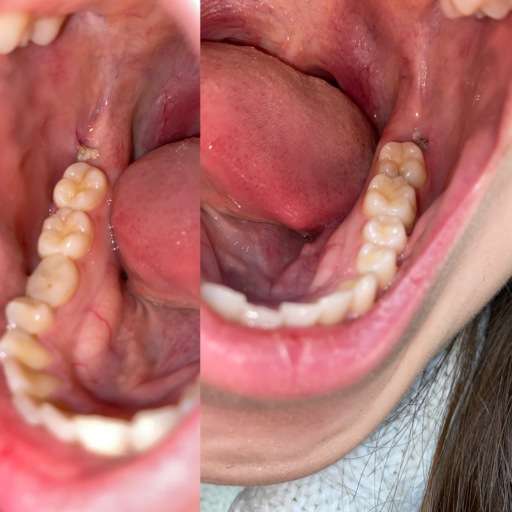 Wisdom Tooth Removal, Infection?