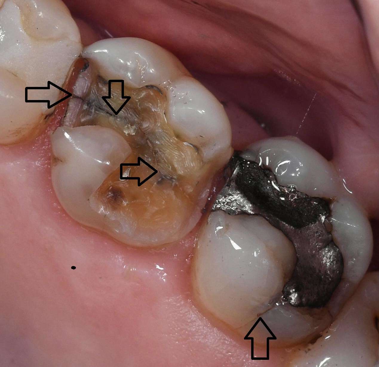 Worn, Cracked or Broken Teeth