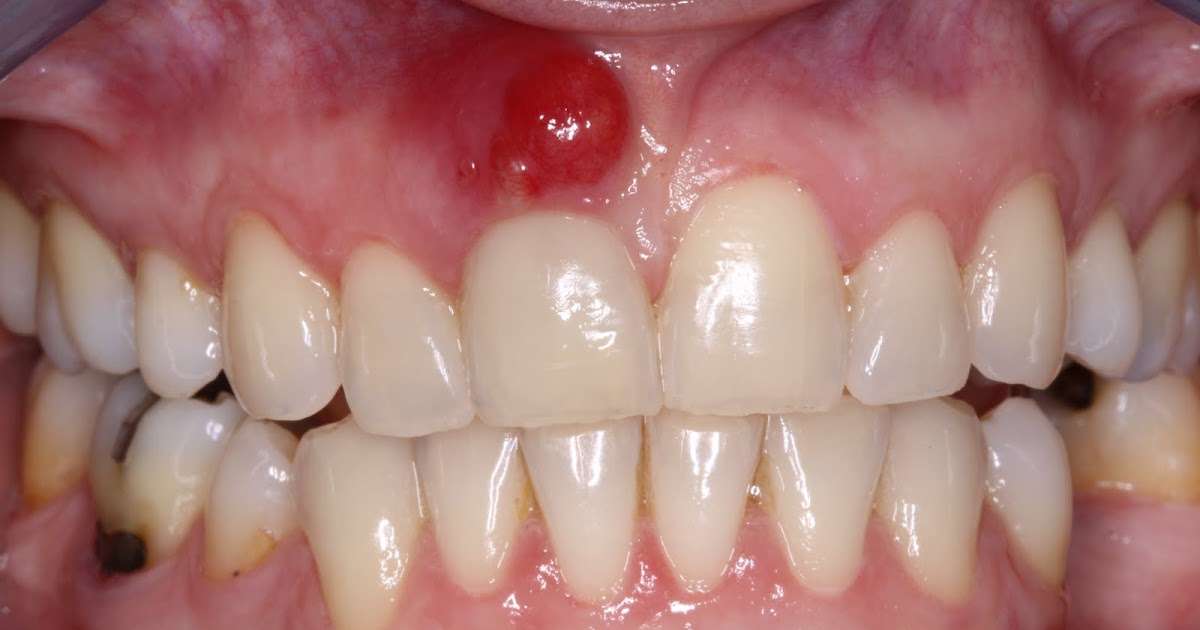 www.BestOgdenDentist.com Blog: Do I have an abscessed tooth?