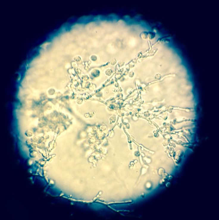 Yeast in Urine under the microscope. Pretty but bad for the patient ...