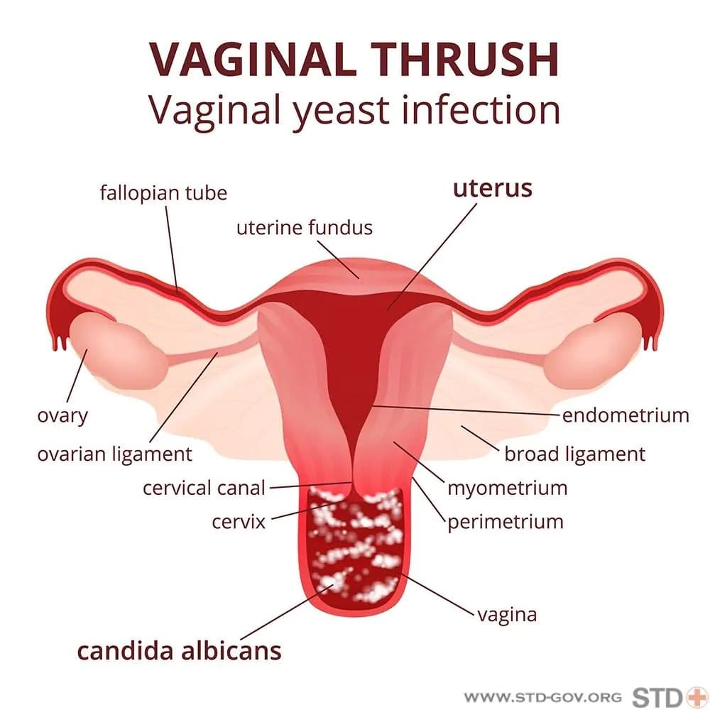Yeast Infections: Natural Remedies